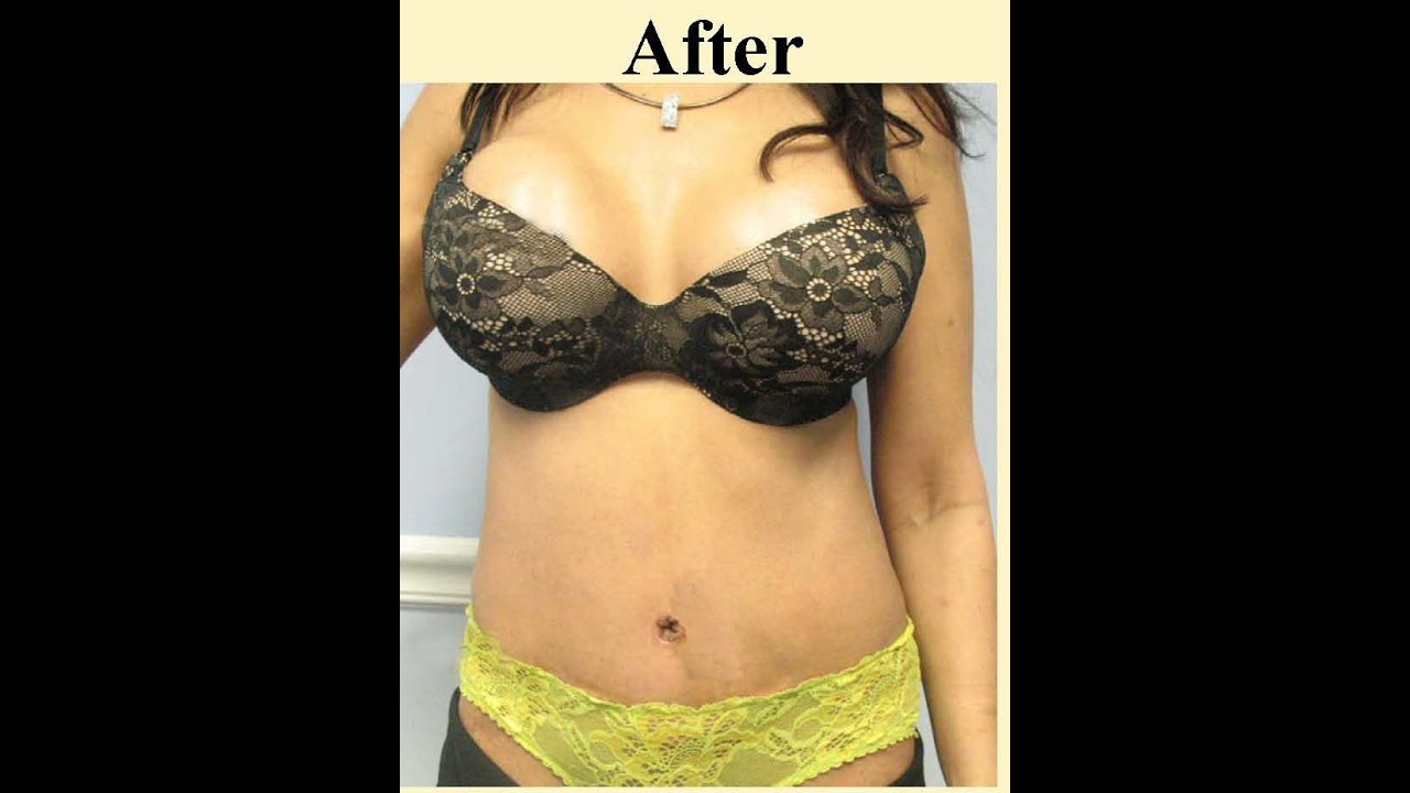 Best Tummy Tuck & J-Plasma