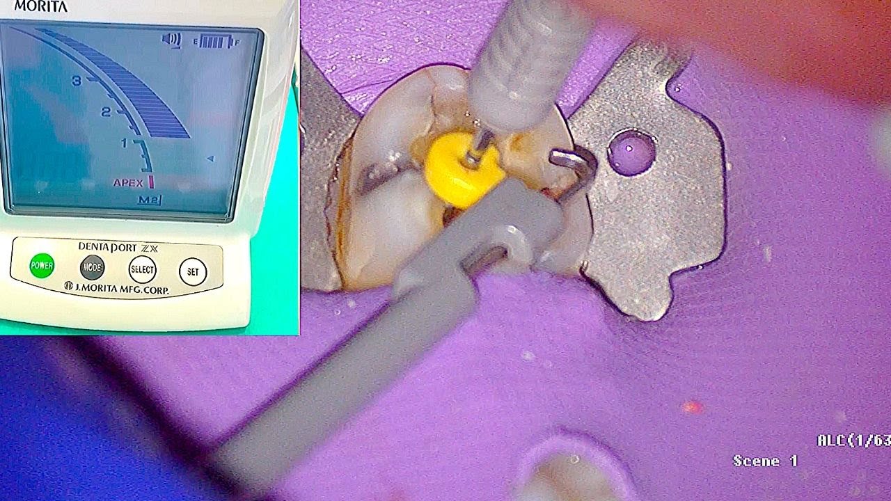 Electronic Apex Locator - Root Canal Working Length Determination