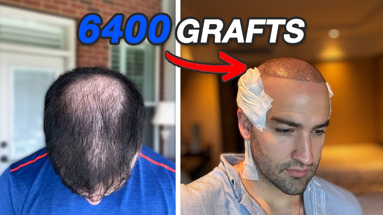 My 2nd Hair Transplant in Turkey | Now Hair Time Clinic | FULL EXPERIENCE 🇹🇷