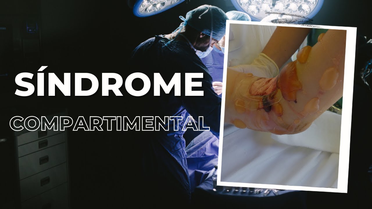 Síndrome compartimental - Prevención, diagnóstico y manejo