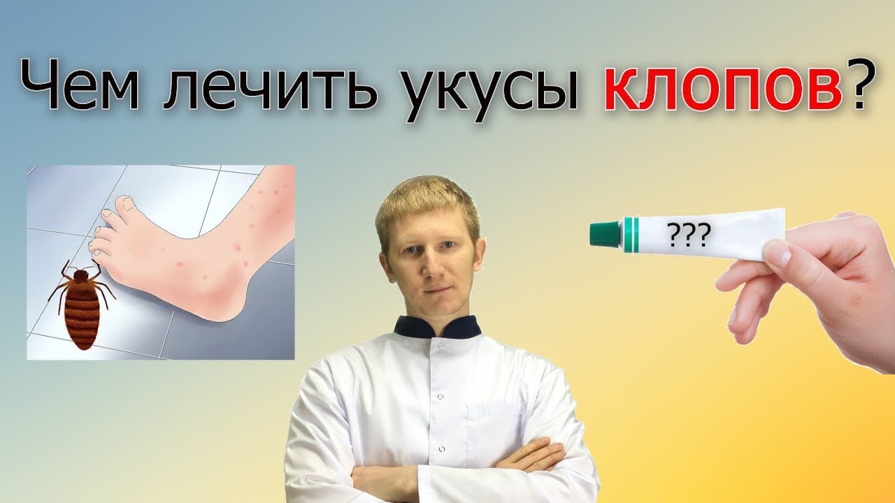Чем ЛЕЧИТЬ укусы КЛОПОВ &mdash; 6 проверенных средств