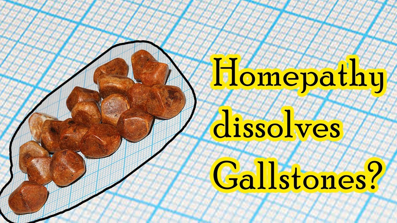 Can homeopathic medicine dissolve gallstones? - Dr. Sanjay Panicker