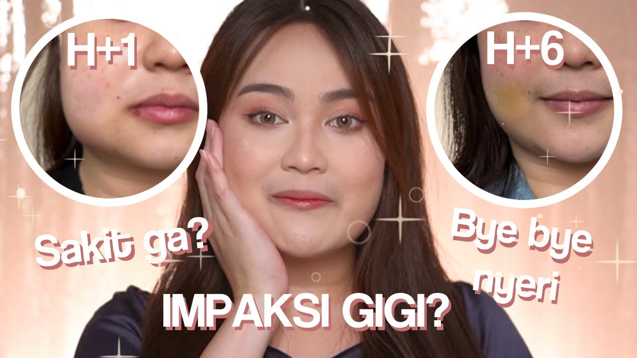 Pengalaman Operasi Impaksi - Bius Lokal!