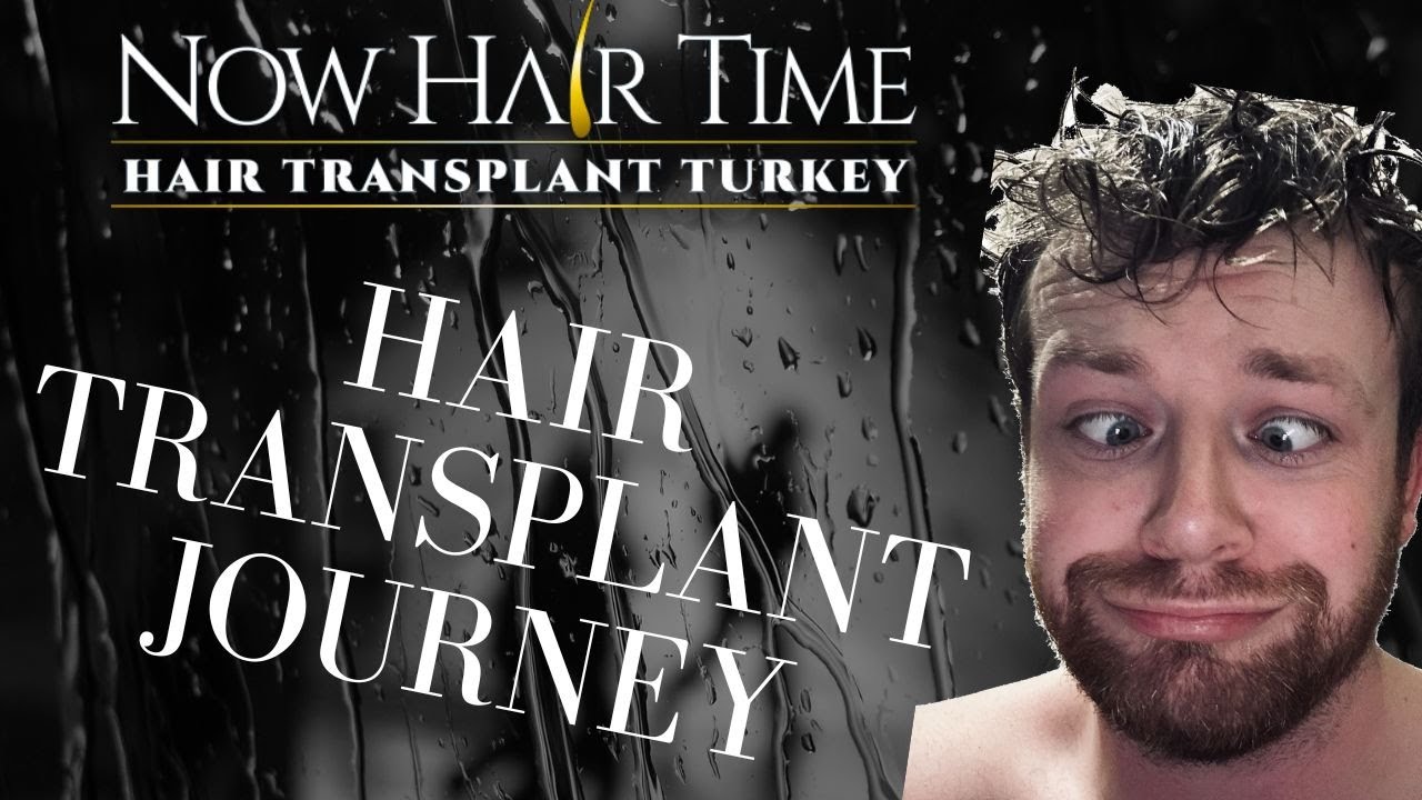 New Hair Who Dis? I Got A Hair Transplant! | @NowHairTime