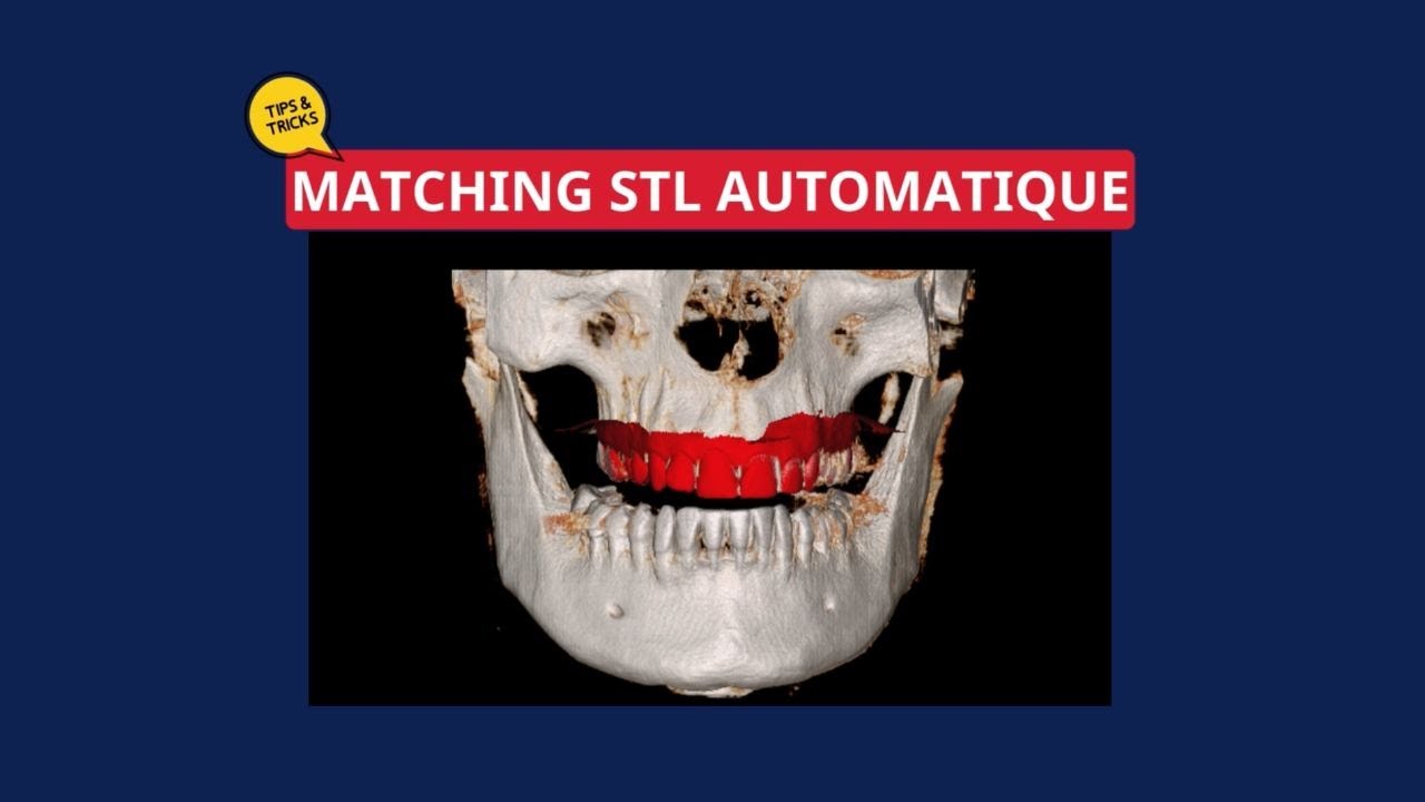 [TIPS & TRICKS]_Matching STL Automatique
