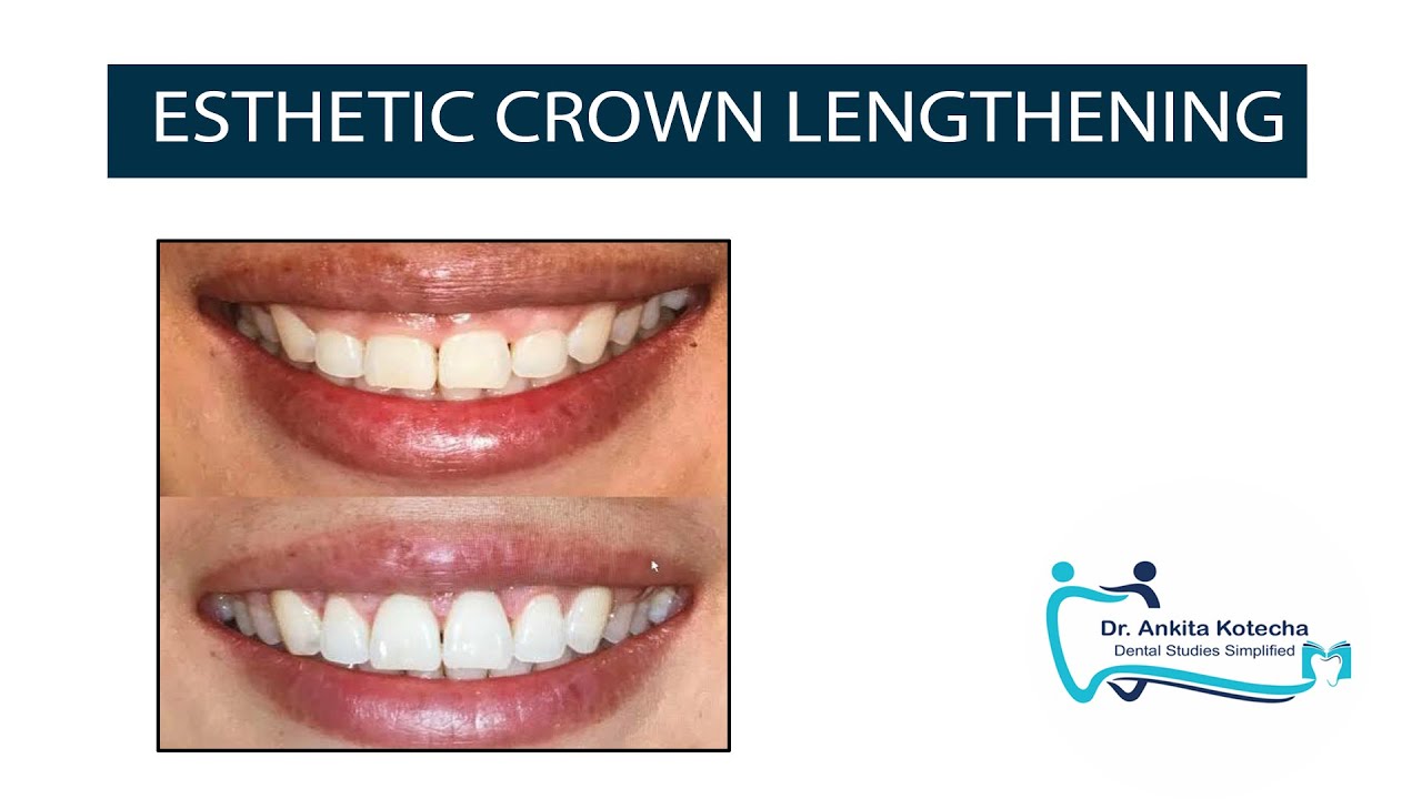 ESTHETIC CROWN LENGTHENING|TREATMENT OF EXCESSIVE GINGIVAL DISPLAY|ALTERED PASSIVE ERUPTION