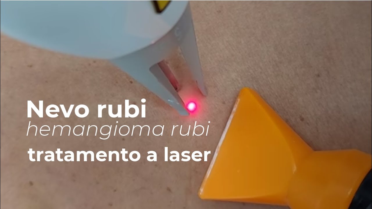 Nevo rubi (hemangioma rubi) - tratamento a laser #shorts