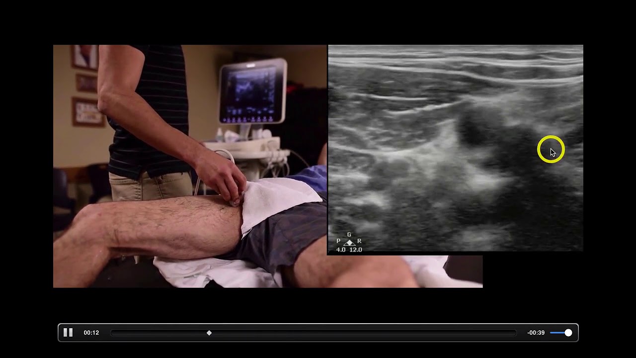 Deep Vein Thrombosis - Diagnosis with Ultrasound