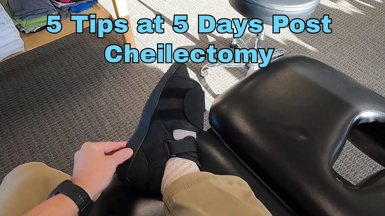 Hallux Rigidus Surgery Day 5: What You NEED To Know