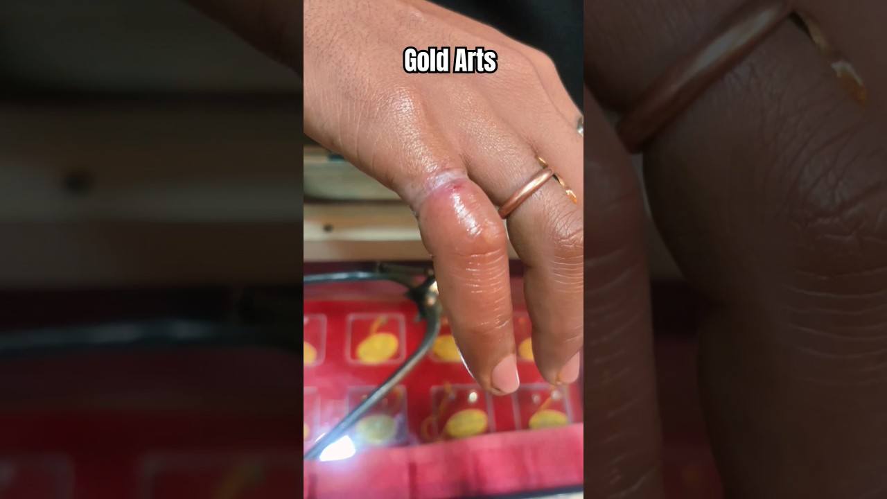 Ring Stuck In Finger #goldsmith #jewellery