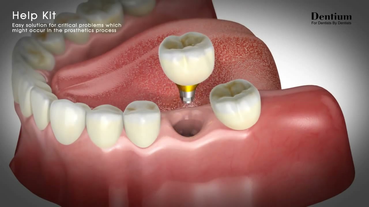 Dentium Help Kit