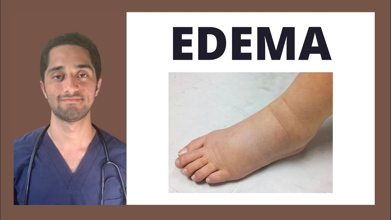 EDEMA | CARDIOLOGÍA