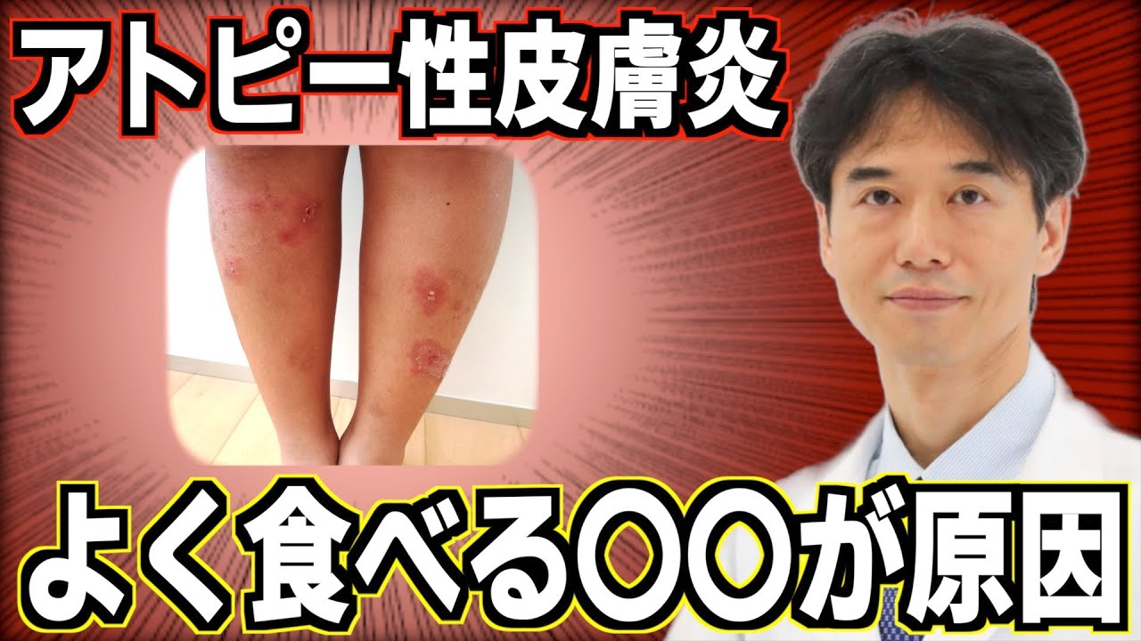 アトピー性皮膚炎が悪化する食べ物とは？肌の湿疹トラブルを改善する食事について解説！