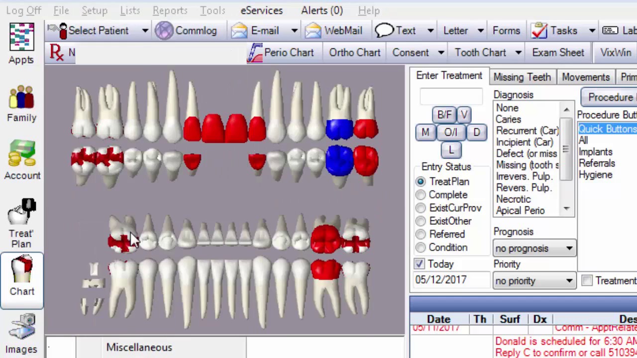 Charting Progress Notes in Open Dental