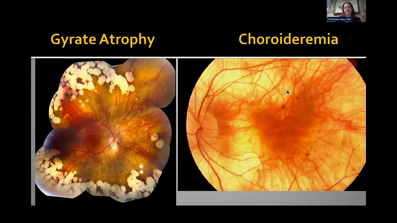 ECP Webinar: Gene Therapies for Inherited Retinal Diseases | March 13, 2025