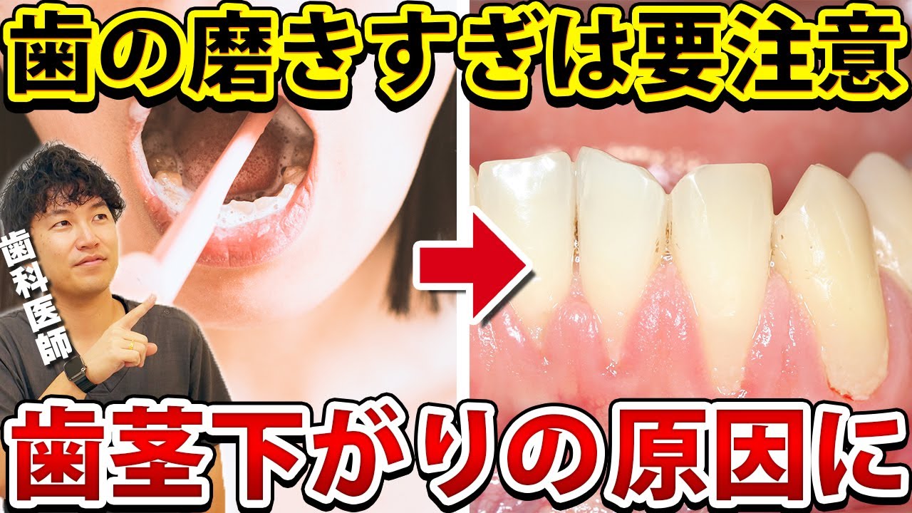 【歯茎下がり】歯の磨きすぎで歯茎が下がる？対処法を歯医者が解説！
