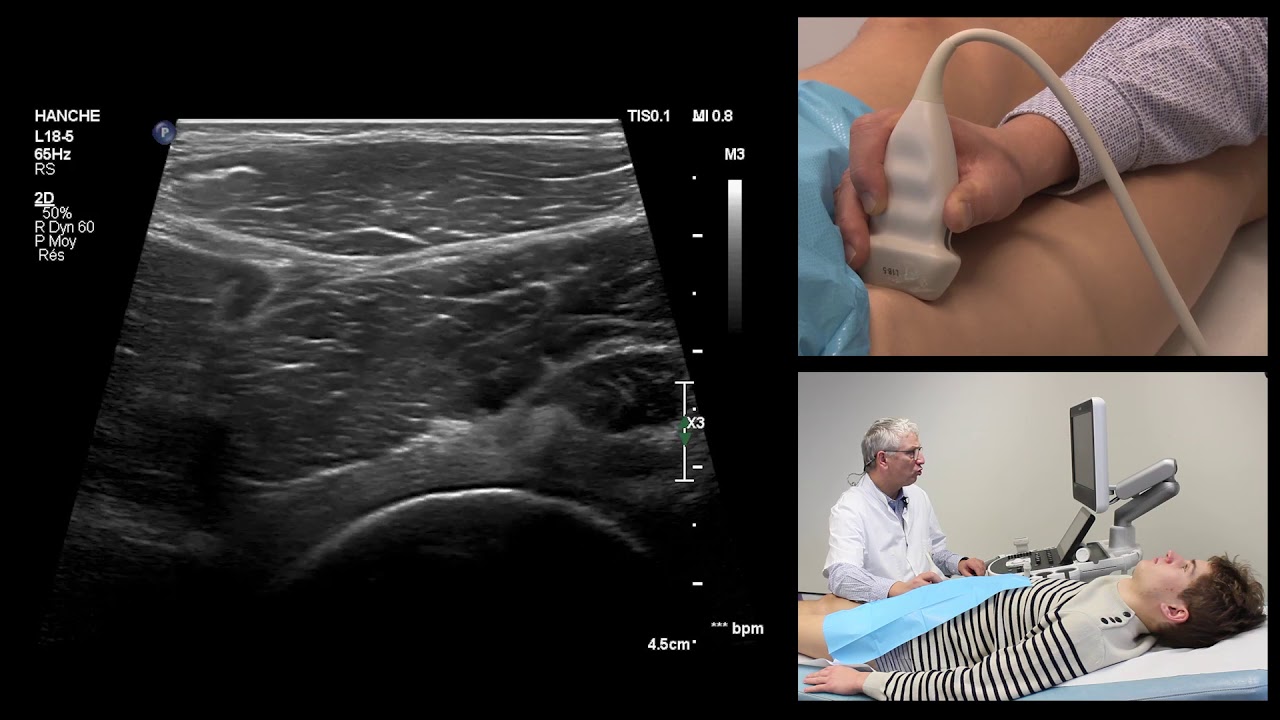 Groin pain and ultrasound - part 5 - Rectus femoris muscle