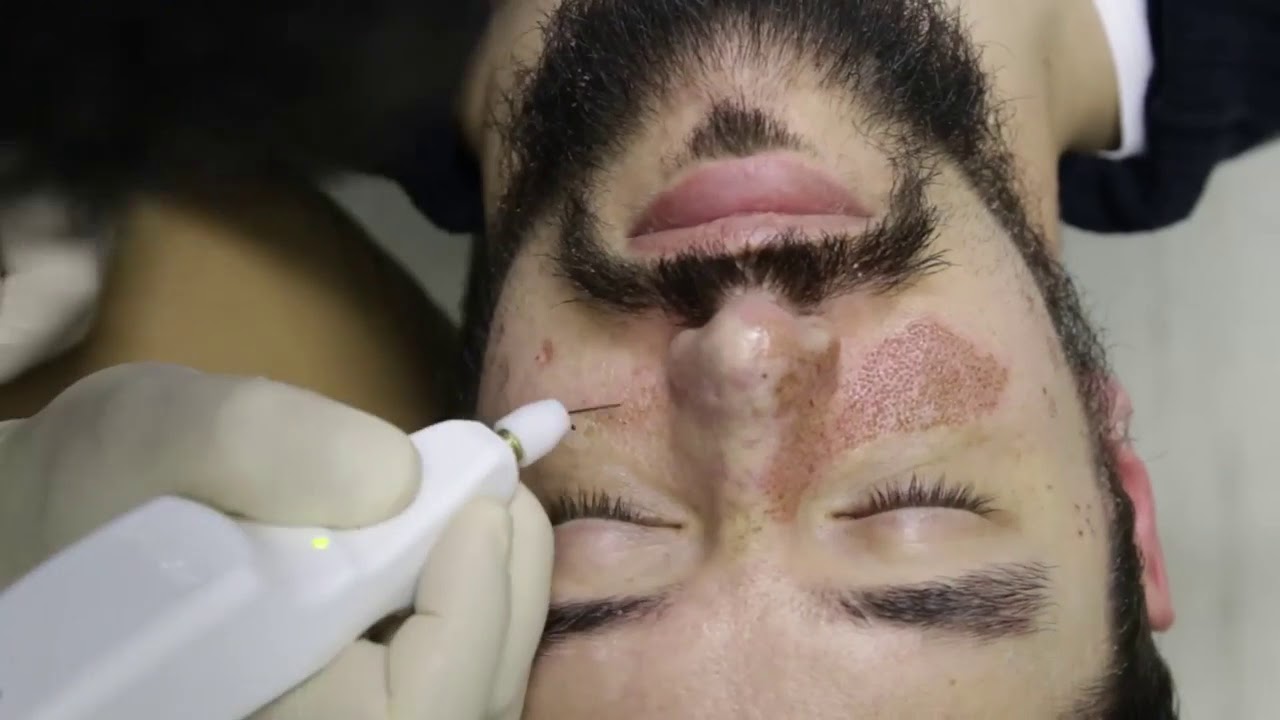 Plexr cihazı ilə Acne Scar m&uuml;alicəsi