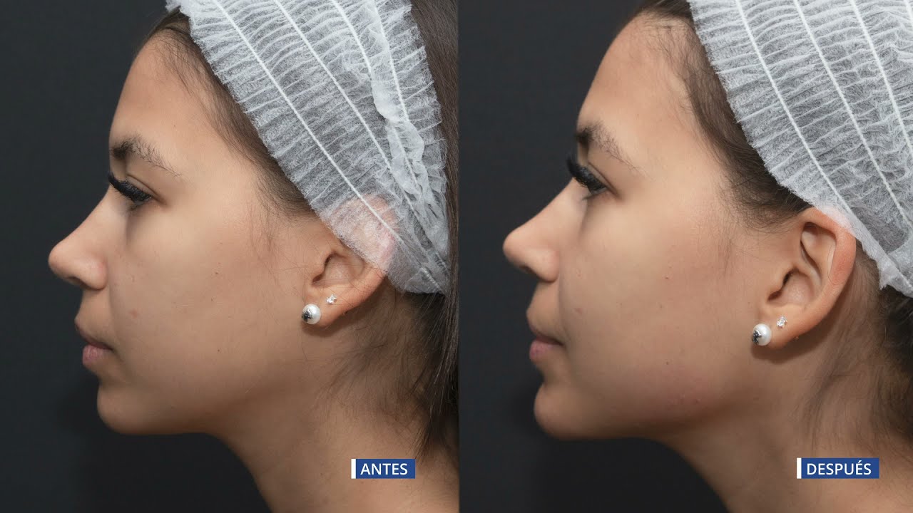 Tratamiento de armonización facial by Dr. Esquivel | Clínicas Esquivel