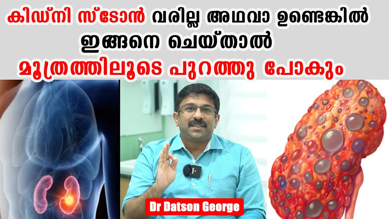 വൃക്കയില്‍ കല്ല്‌ വരില്ല  അഥവാ ഉണ്ടെങ്കിൽ മൂത്രത്തിലൂടെ പുറത്തു പോകും ഇങ്ങനെ ചെയ്താൽ /Baiju's Vlogs