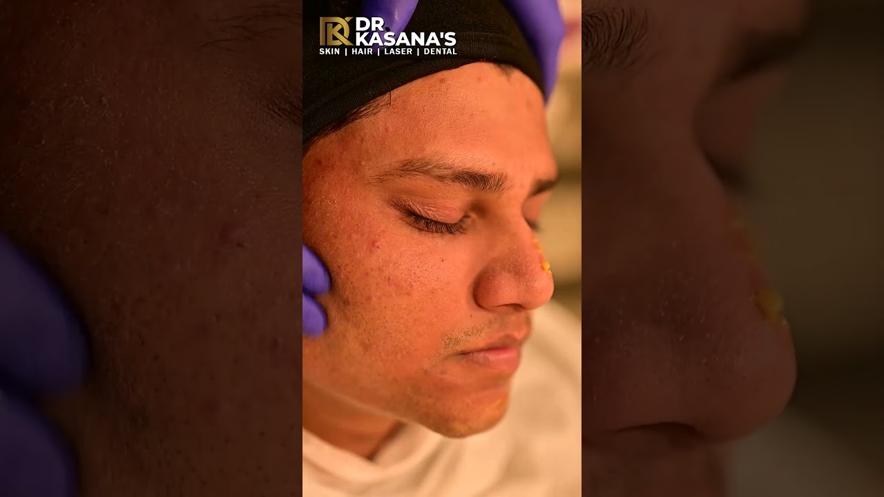 yellow peel treatment at dr kasana clinic