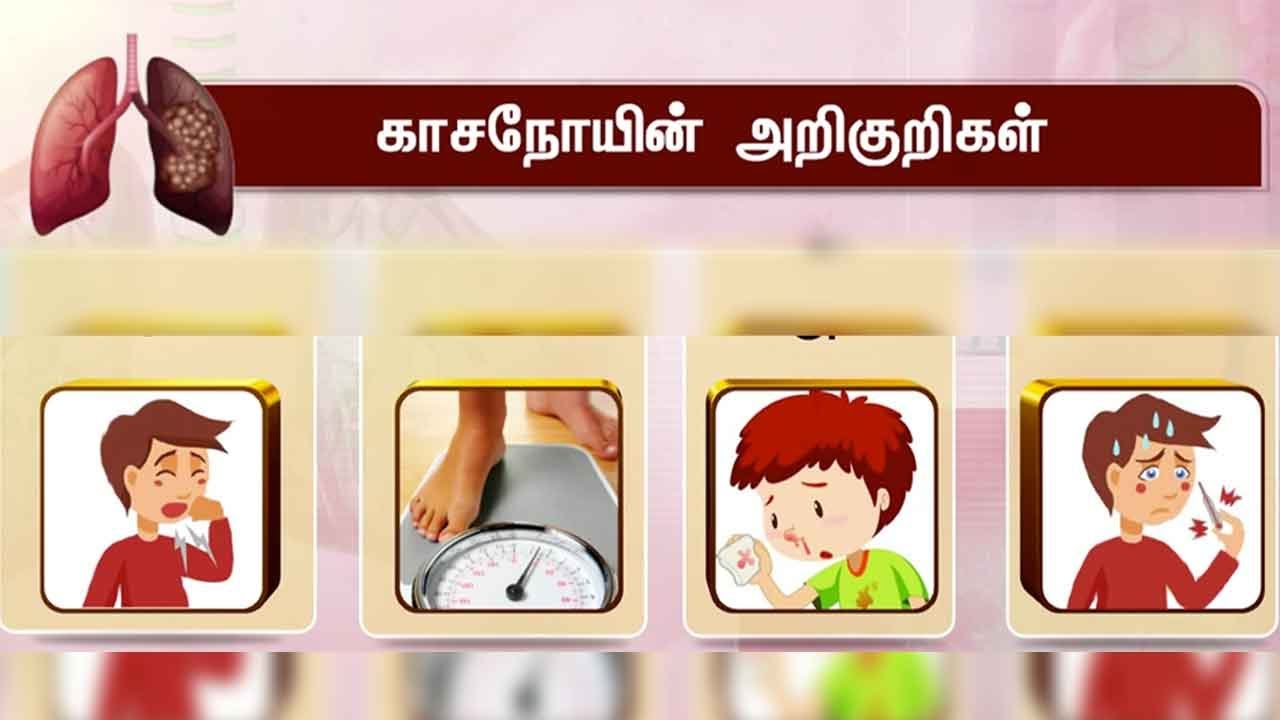காசநோயின் அறிகுறிகள் என்னென்ன?