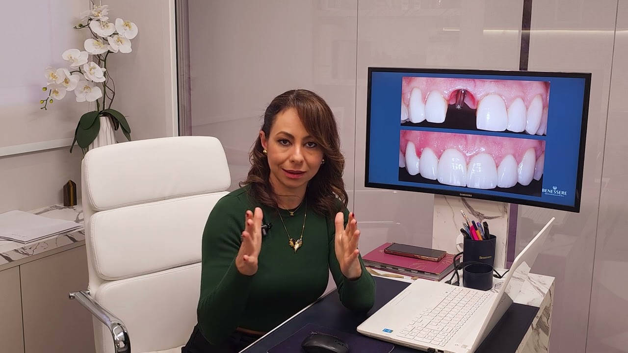 Cuidados Essenciais para Implantes Dentários em Região Estética | Benessere Odontologia