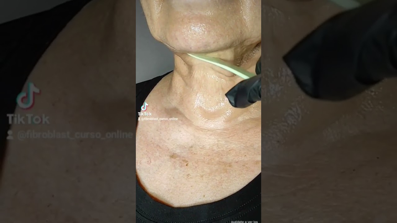 Aprende a tensar la piel fl&aacute;cida del cuello #fibroblast #plasmapen #plasma #sincirugia #sinarrugas
