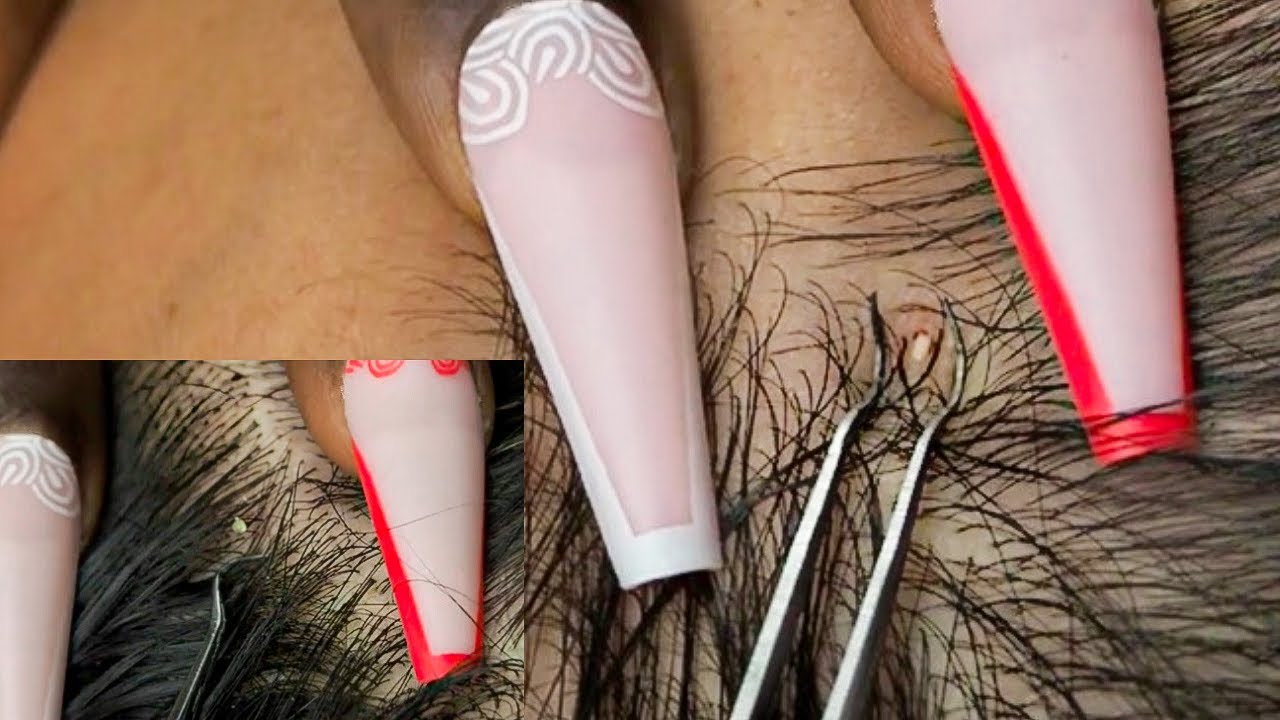 ASMR | Close Concetration NITPICKING The Scalp | soft whispers 💭