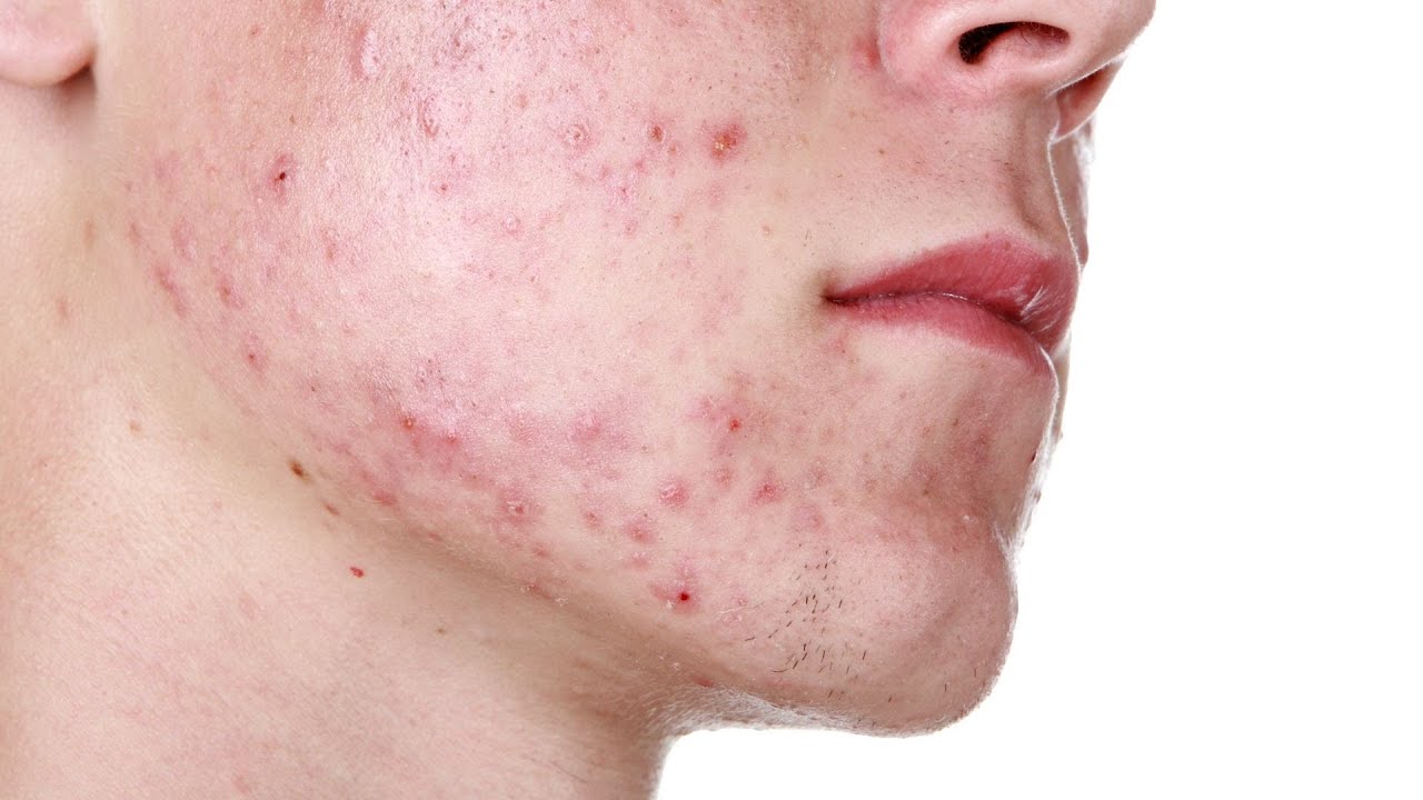 How to Shave Acne-Prone Skin | Shaving Tips
