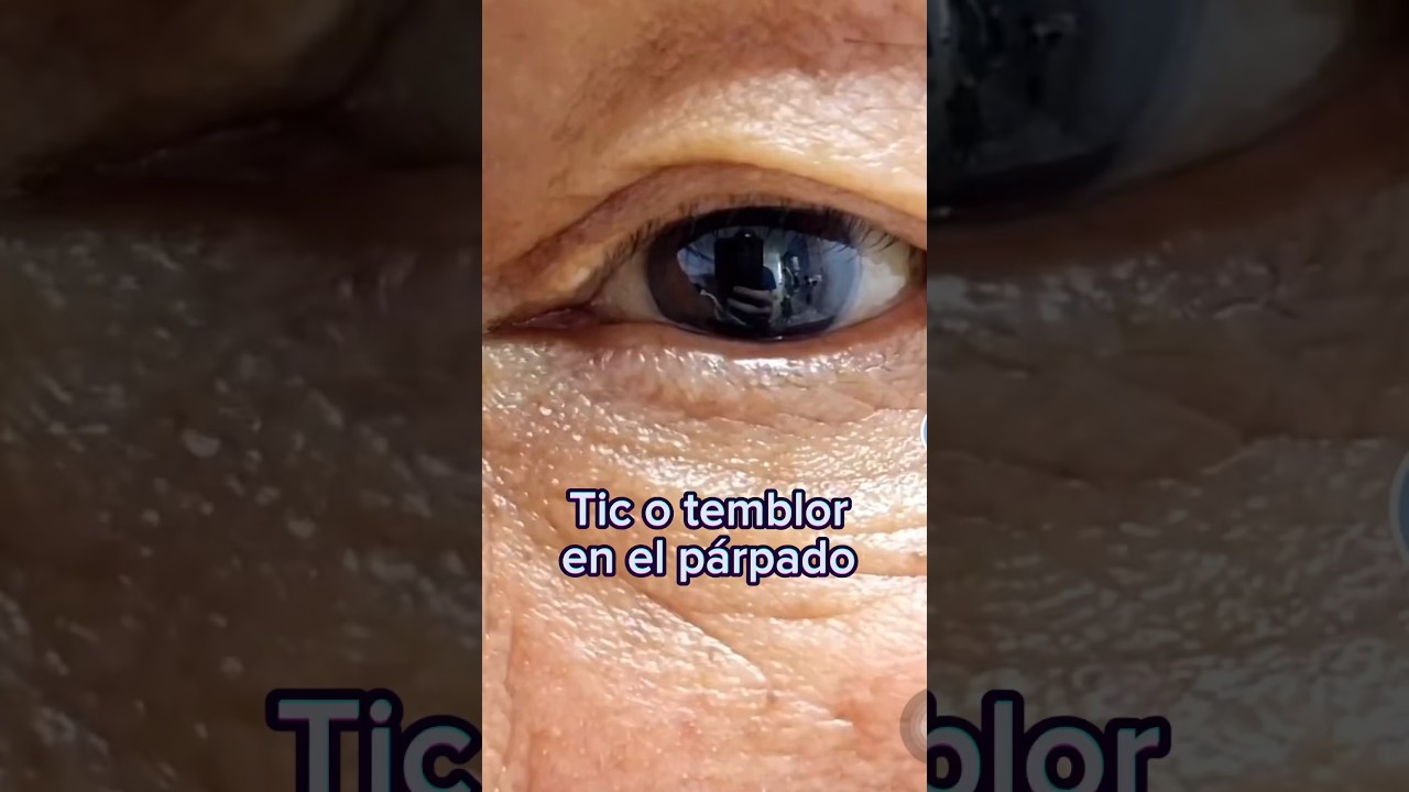 &iquest;Les ha pasado? Tic o temblor en el p&aacute;rpado del ojo | Dr. William Guerrero. #shorts #medicina