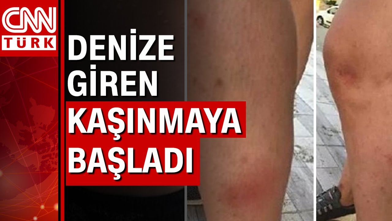 Sakarya Karasu'da denize giren kaşınmaya başladı