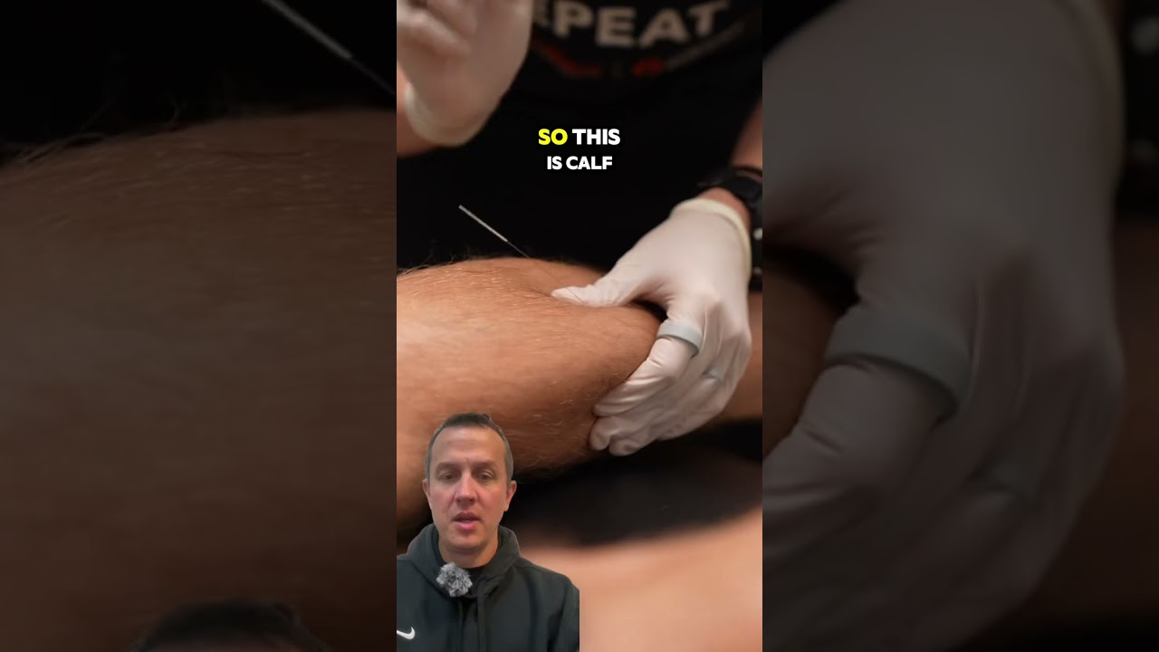 Twitch Response While Dry Needling the Calf