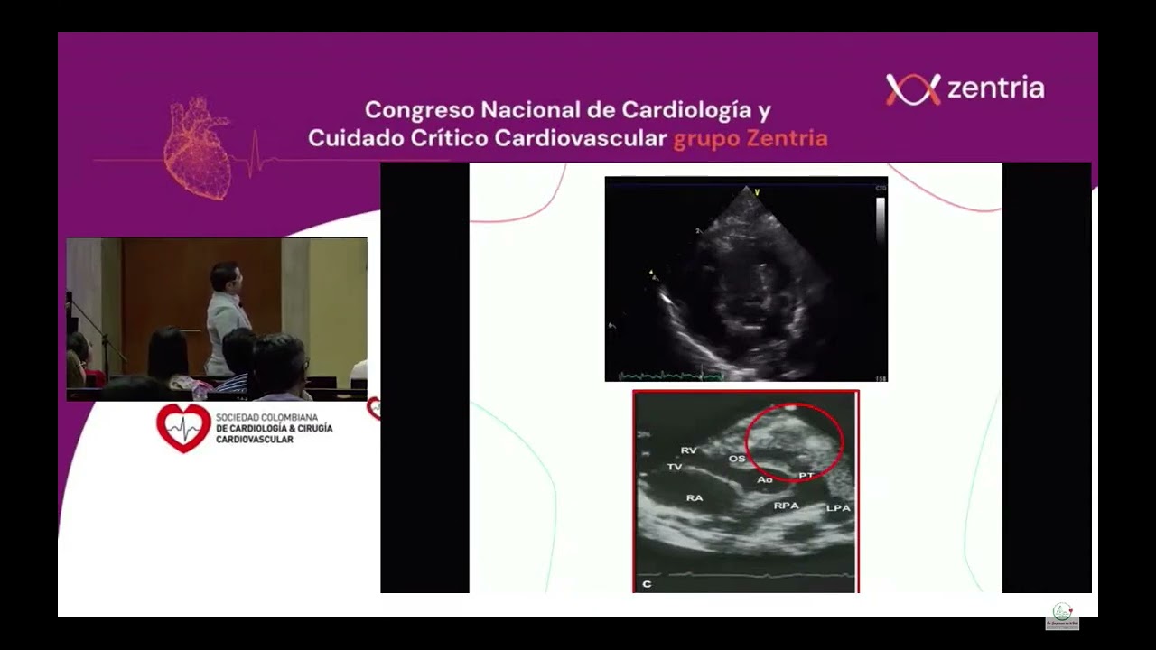 TETRALOGIA DE FALLOT CONGRESO ZENTRIA