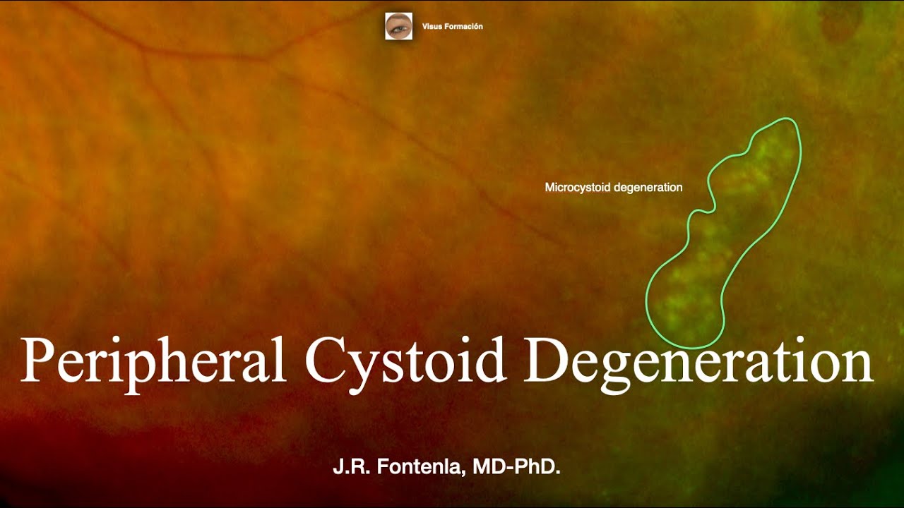 Peripheral Cystoid Degeneration. Peripheral Retinal Degenerations.