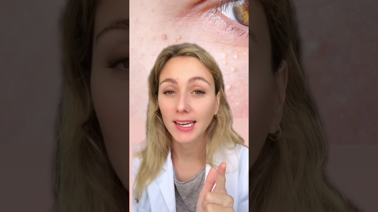 Quistes de millium #skincare #skincareroutine #skincaretips