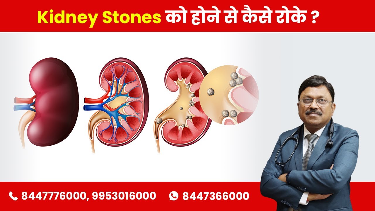How To Prevent Kidney Stones? | By Dr. Bimal Chhajer | Saaol