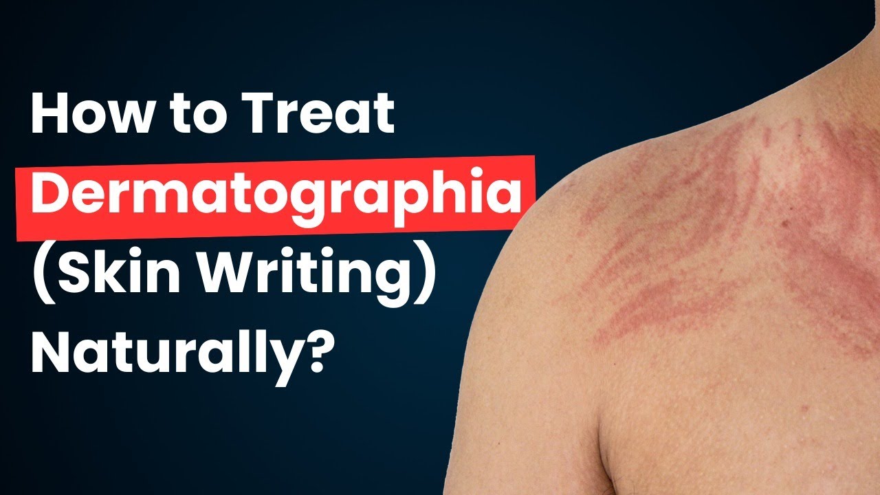 How to Treat Dermatographia (Skin Writing) Naturally? #urticaria #hive 