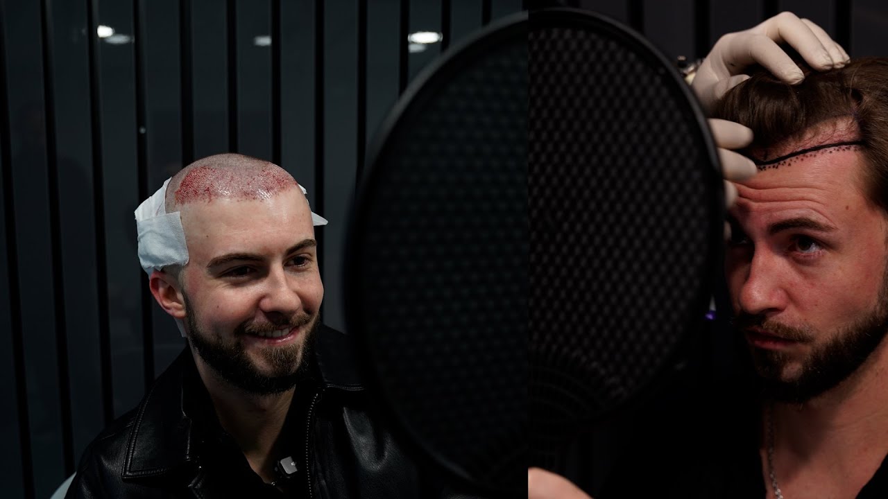 J'ai choisi Bellahair en Turquie pour une greffe de cheveux.🔥