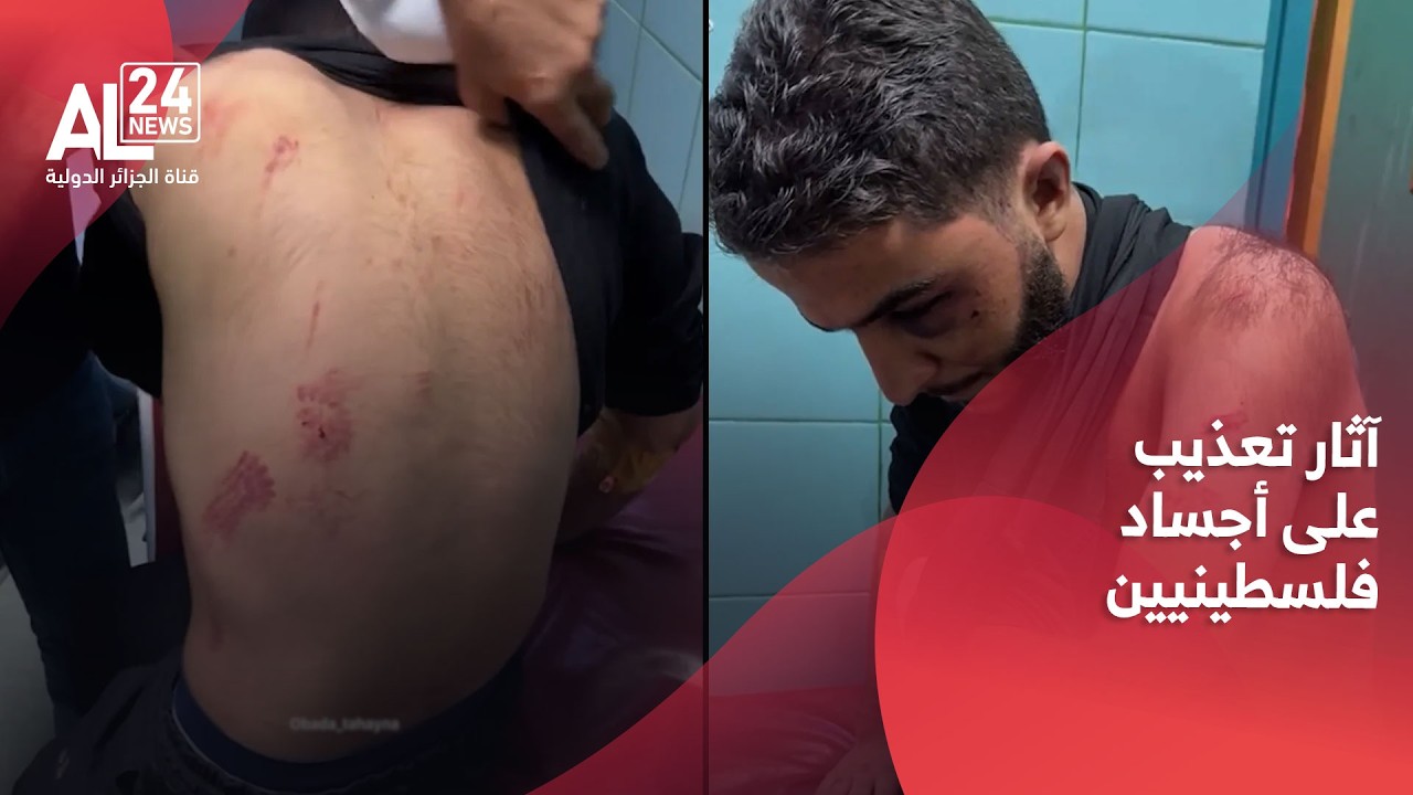 غزة | آثار تعذيب على أجساد معتقلين في سجون الاحتلال
