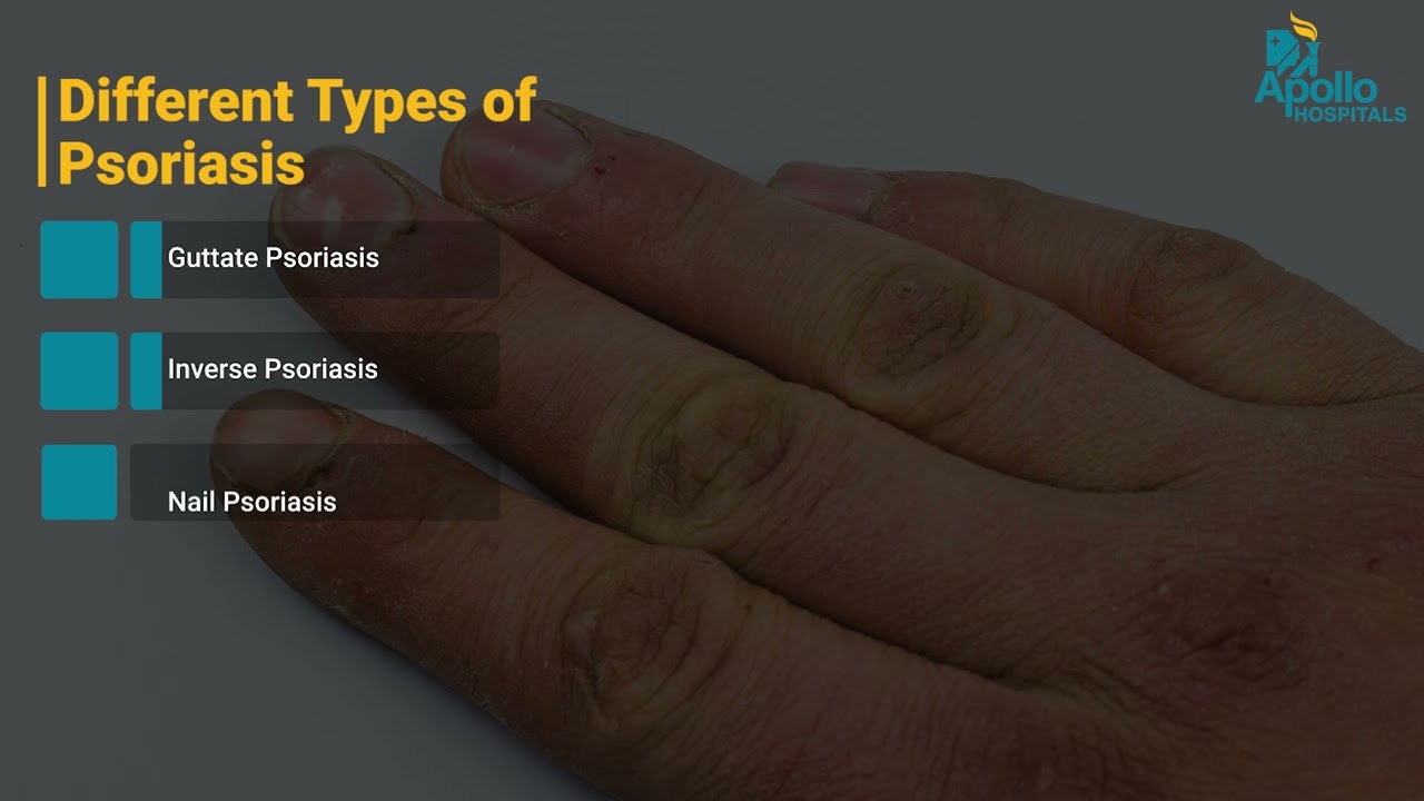 Psoriasis: Causes, Symptoms, Diagnosis & Treatment