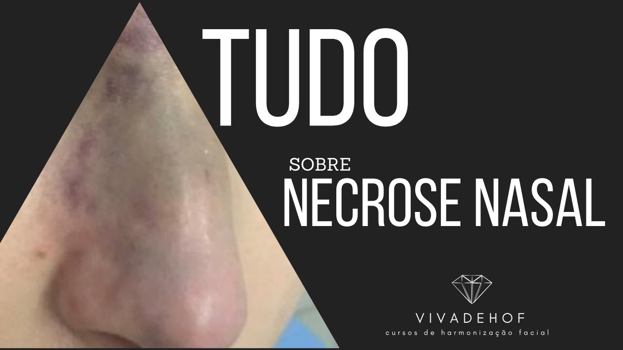 TUDO SOBRE NECROSE NASAL
