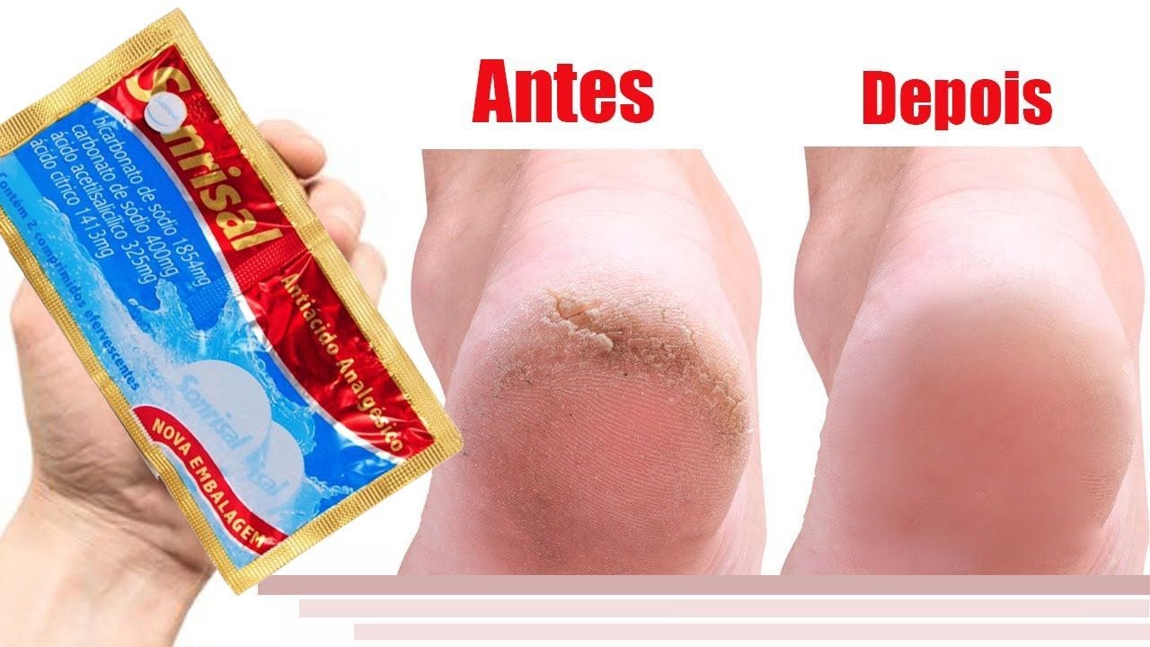 COM  R$ 2,00 🤩 pés lisos hidratados com Sonrisal