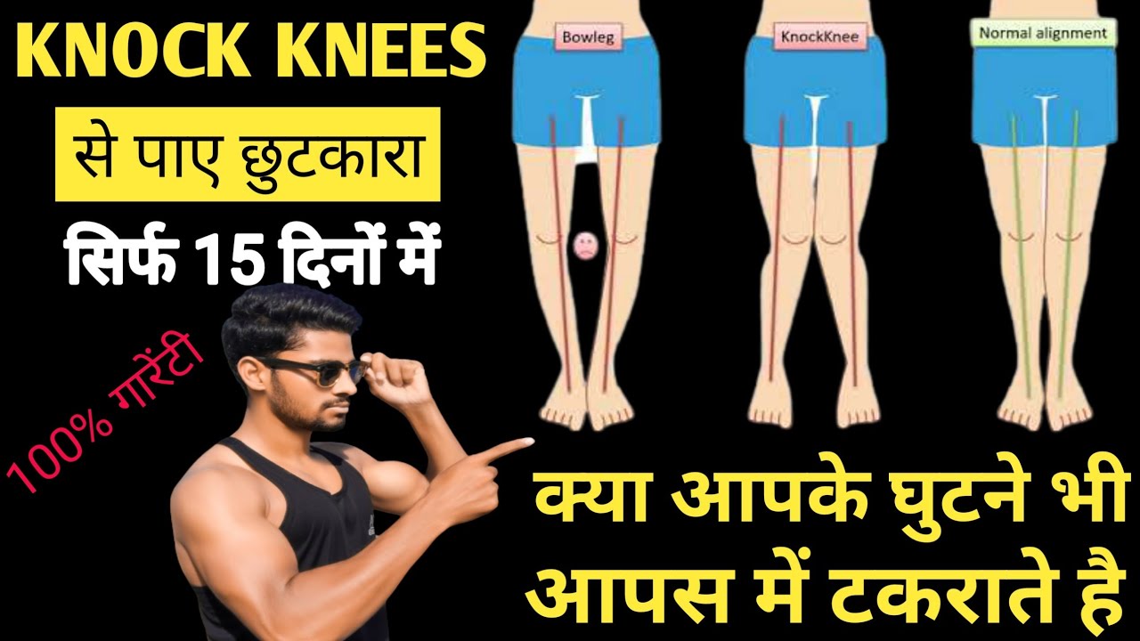 Knock knee problem solution | knock knee कैसे ठीक करे | knock knee correction exercise | knock knee|