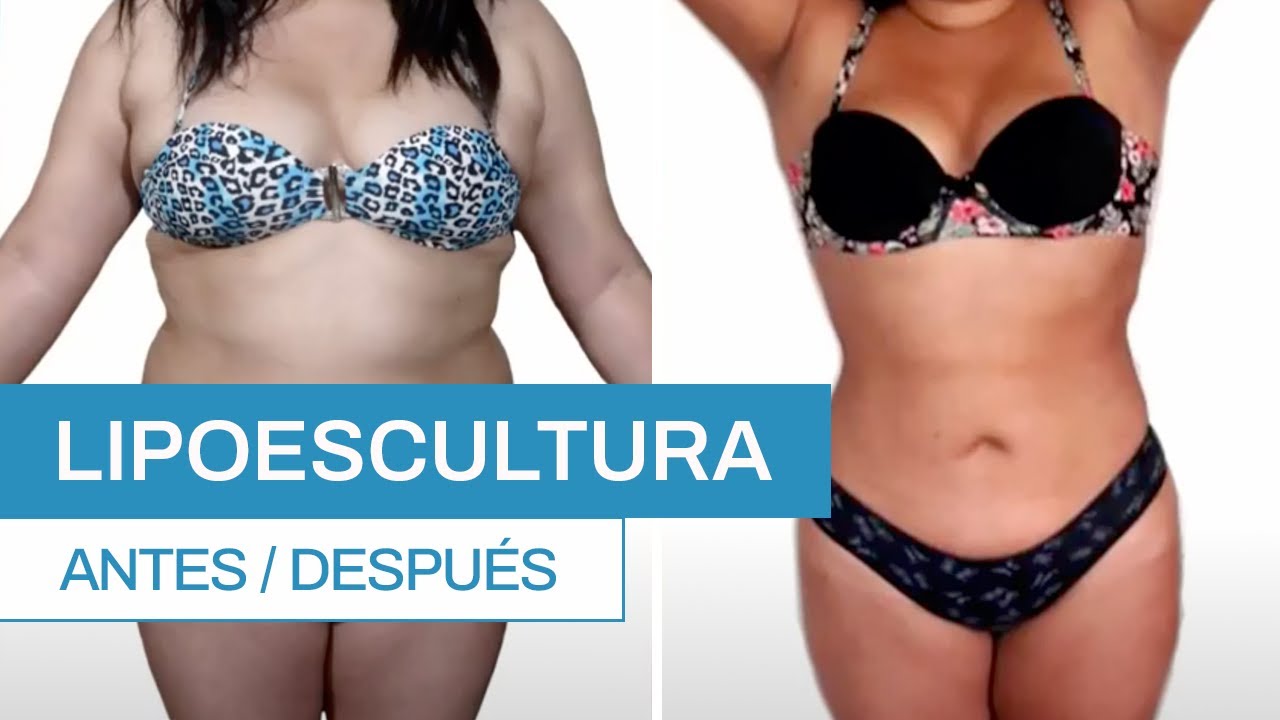 ¿Cómo es una Lipoescultura? Antes y después | Clínica Barrenechea