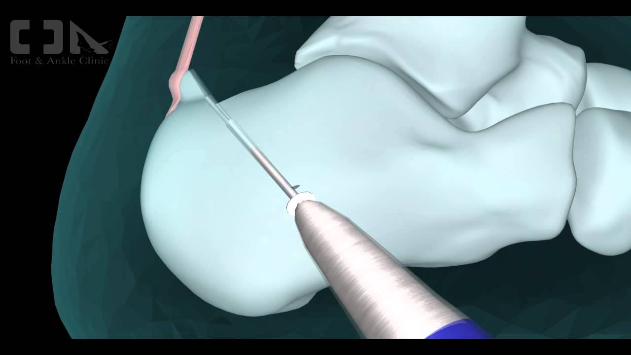 Minimally Invasive  Haglund's Deformity Surgery