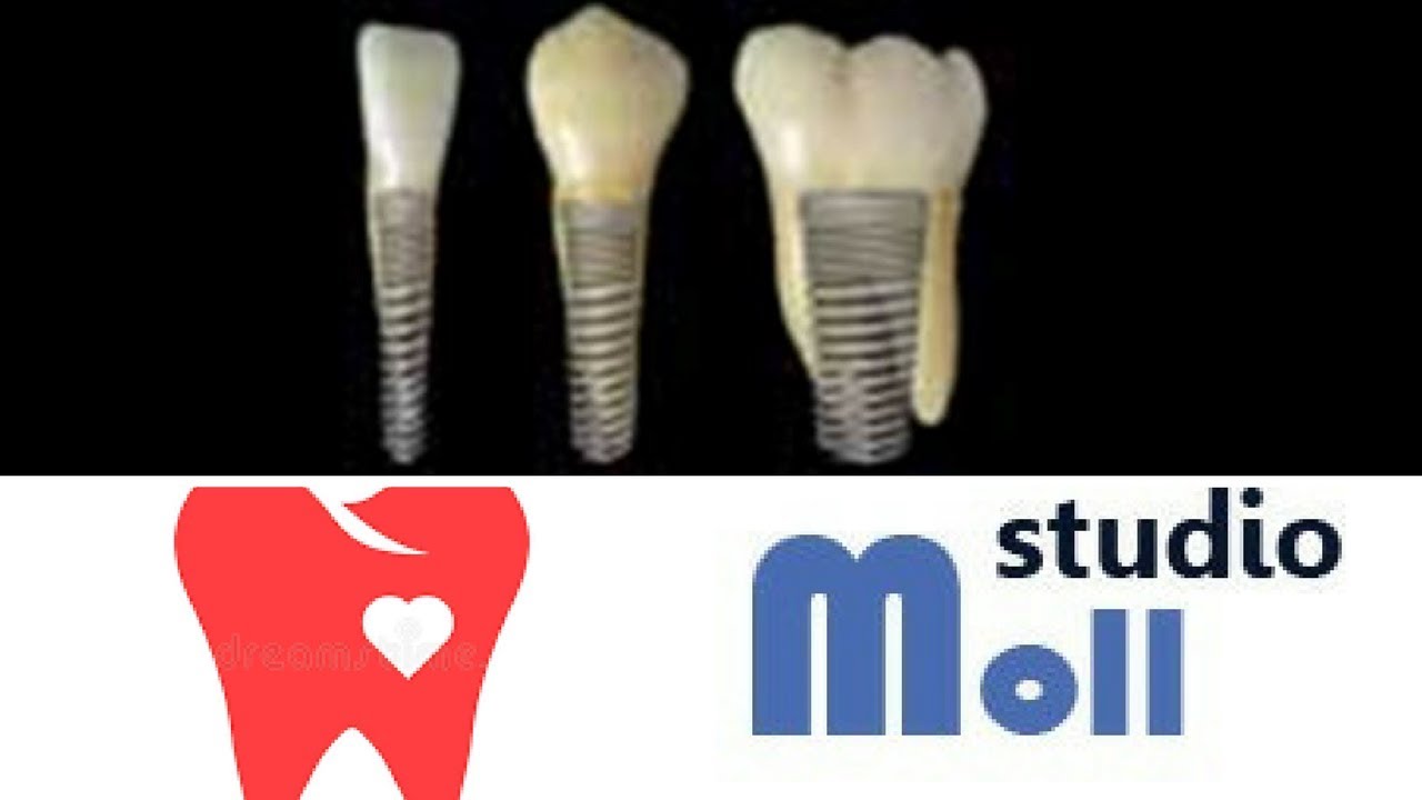 Come trattare la perimplantite e la peri-mucosite?