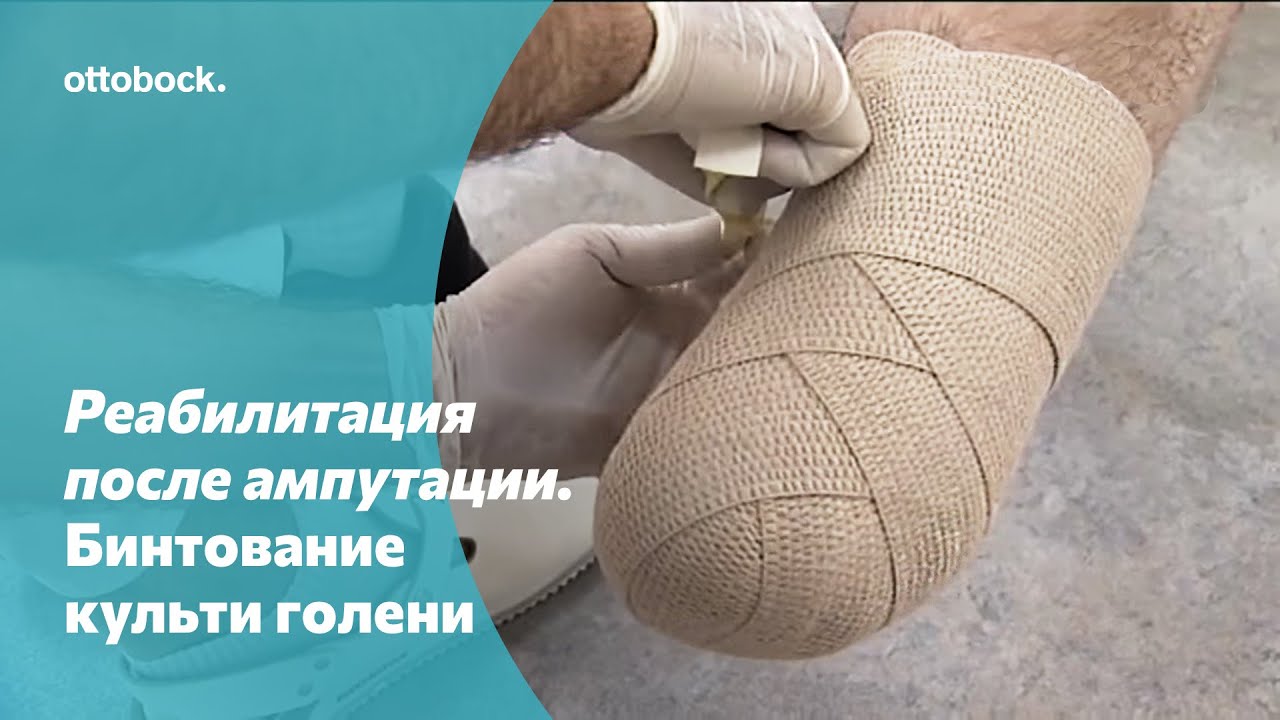 Реабилитация после ампутации. Компрессионная терапия: техника бинтования культи голени