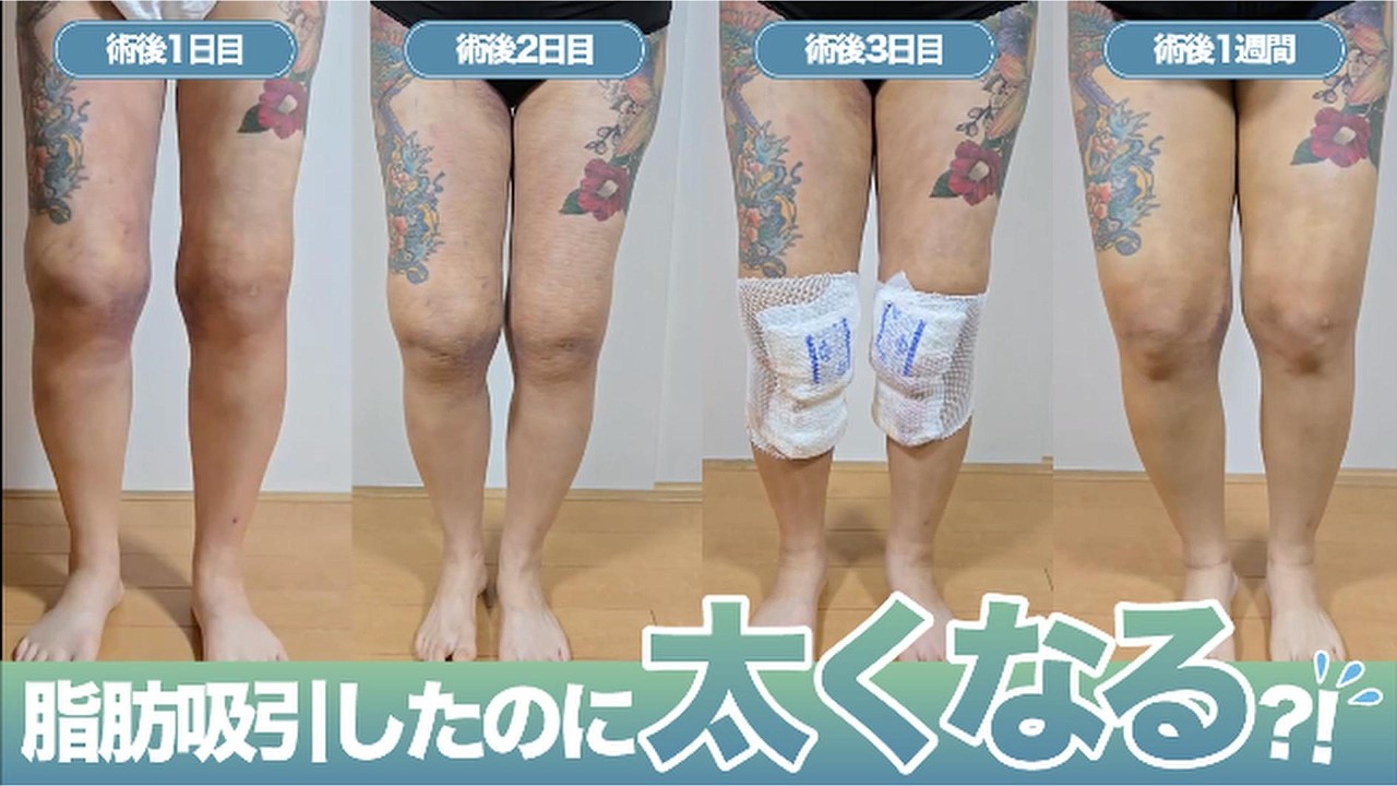 大量吸引5000ccのダウンタイムで絶望【太もも脂肪吸引】【30代女性】