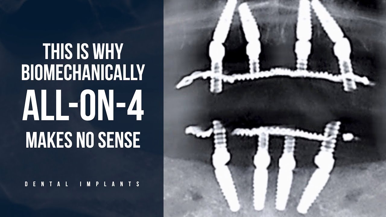 This is why biomechanically ALL-ON-4 makes no sense